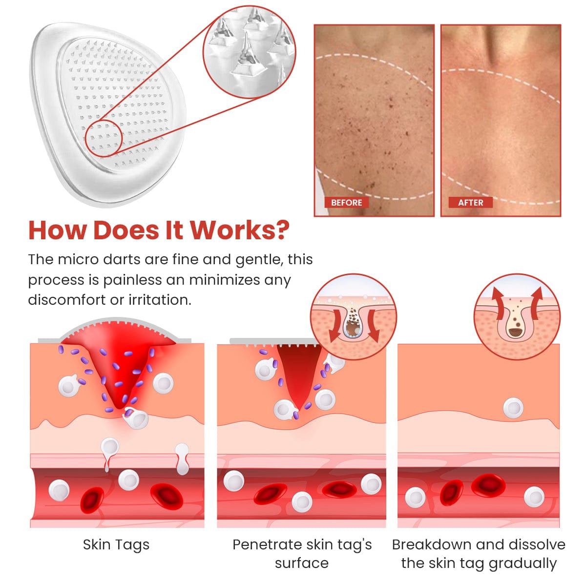 Luhaka® DermaSmooth Skin Tag Remover Patch 2